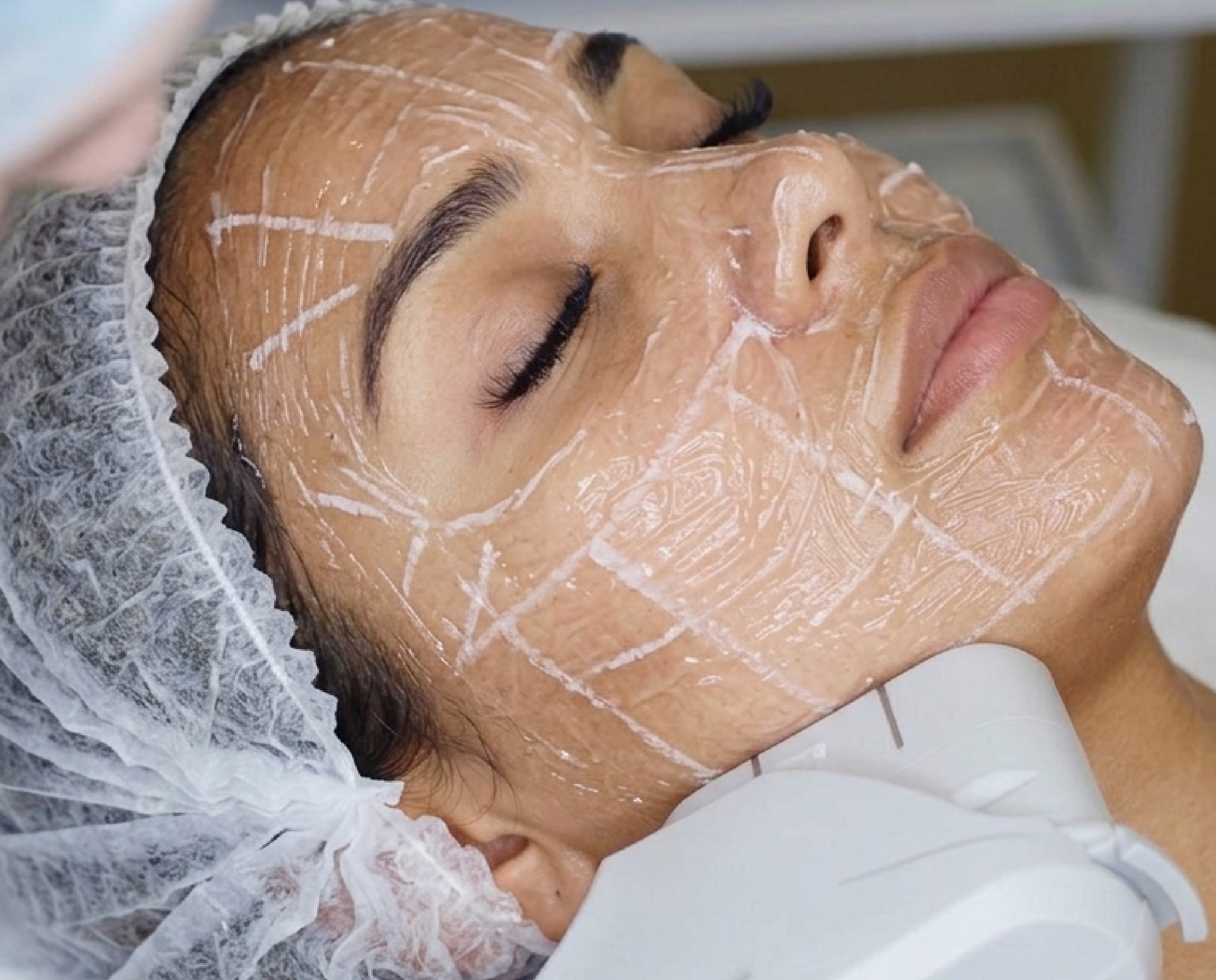HIFU ultrasound treatment results at Vive Medical Spa Tijuana