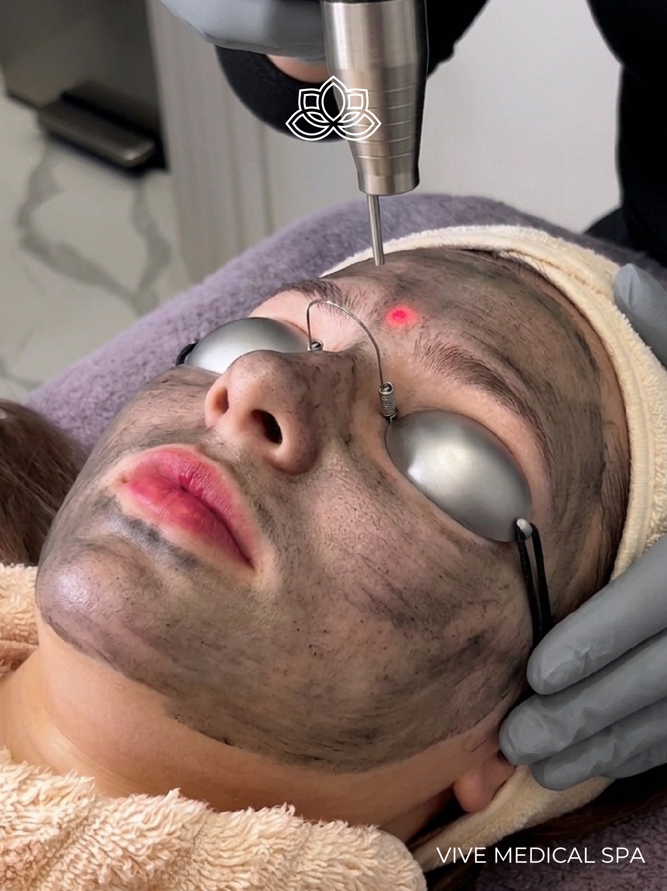Hollywood Peel results at Vive Med Spa
