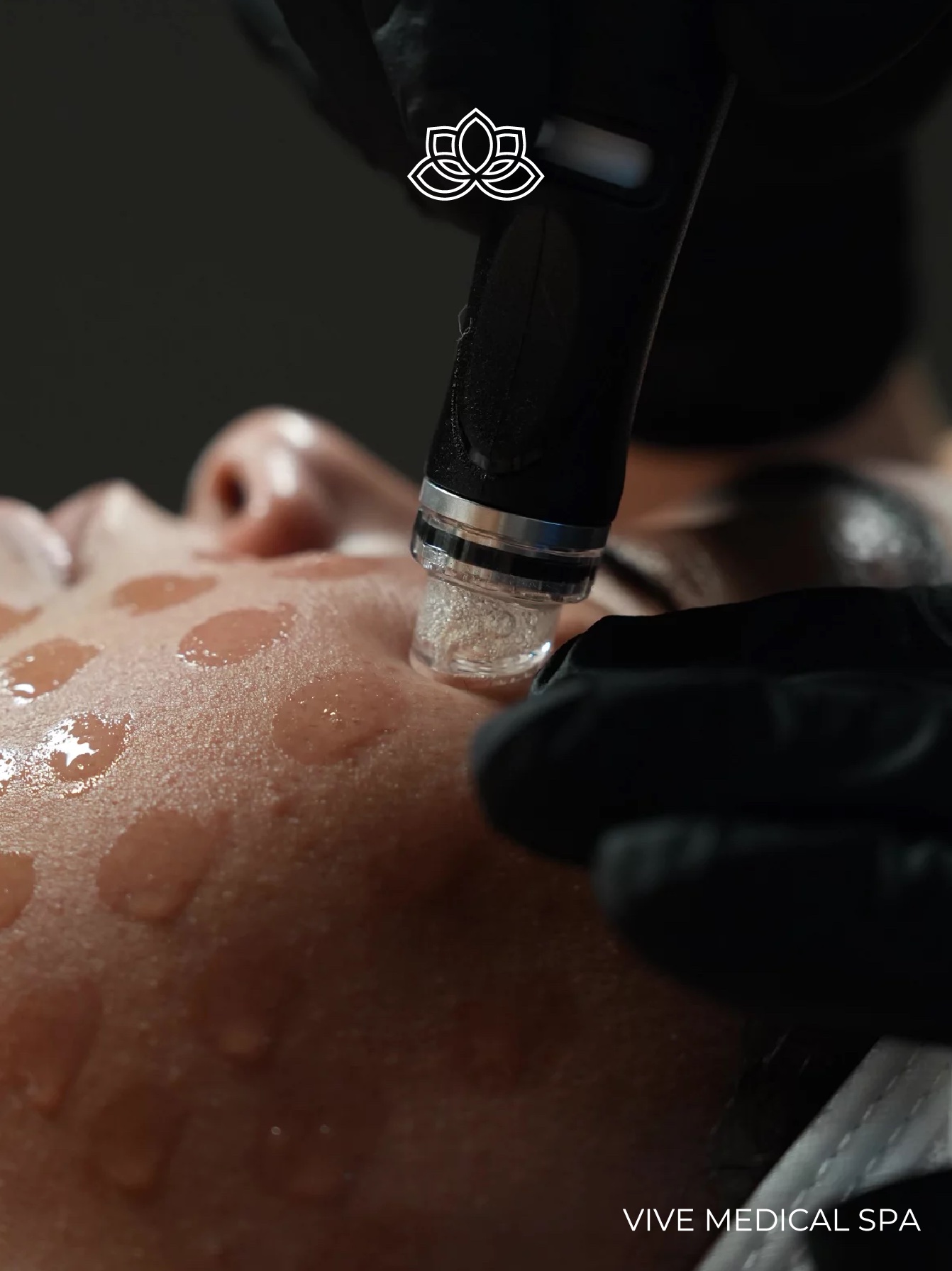 Hydrafacial treatment at Vive Med Spa Tijuana