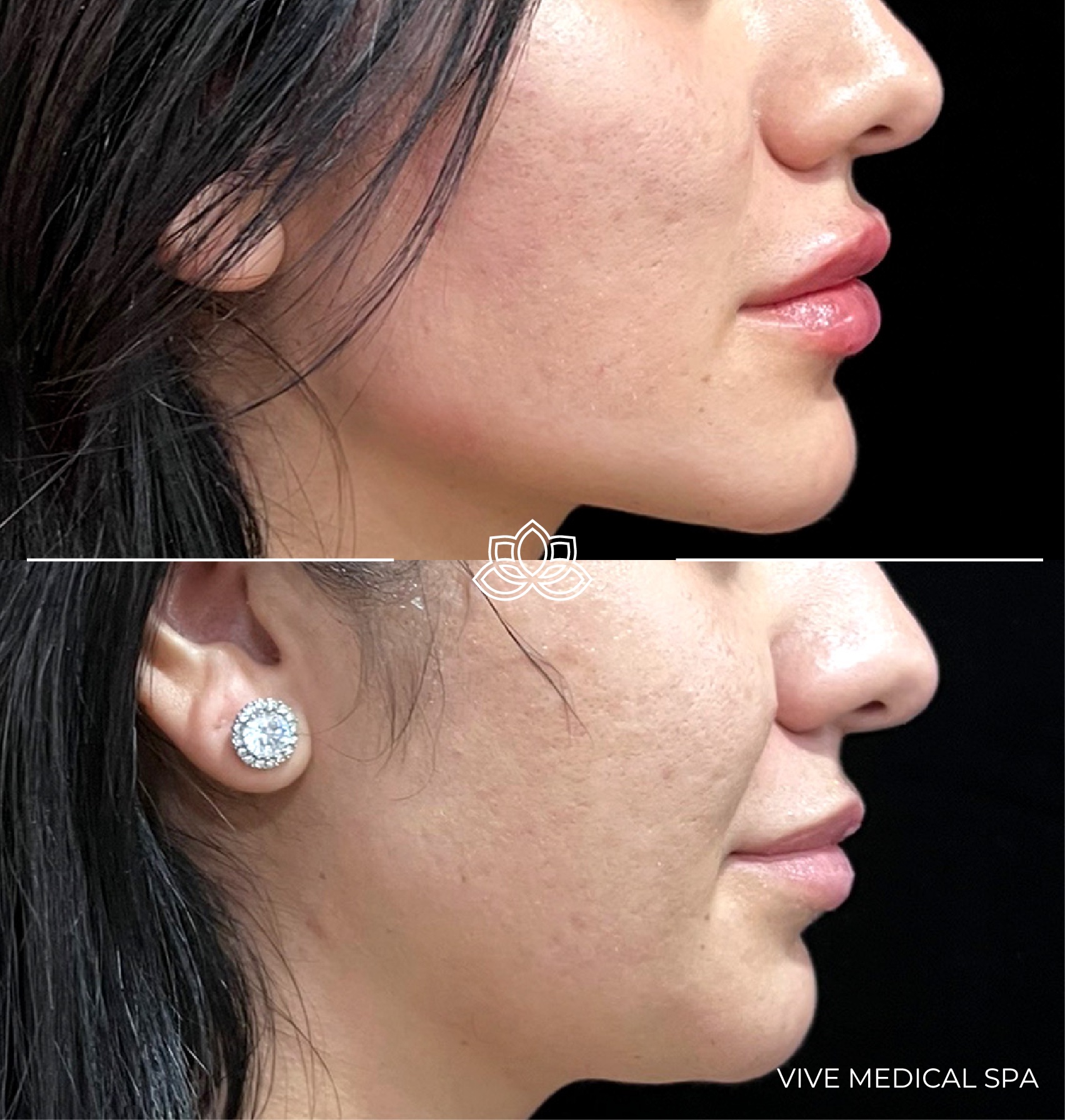 Jaw contouring results - Vive Medical Spa