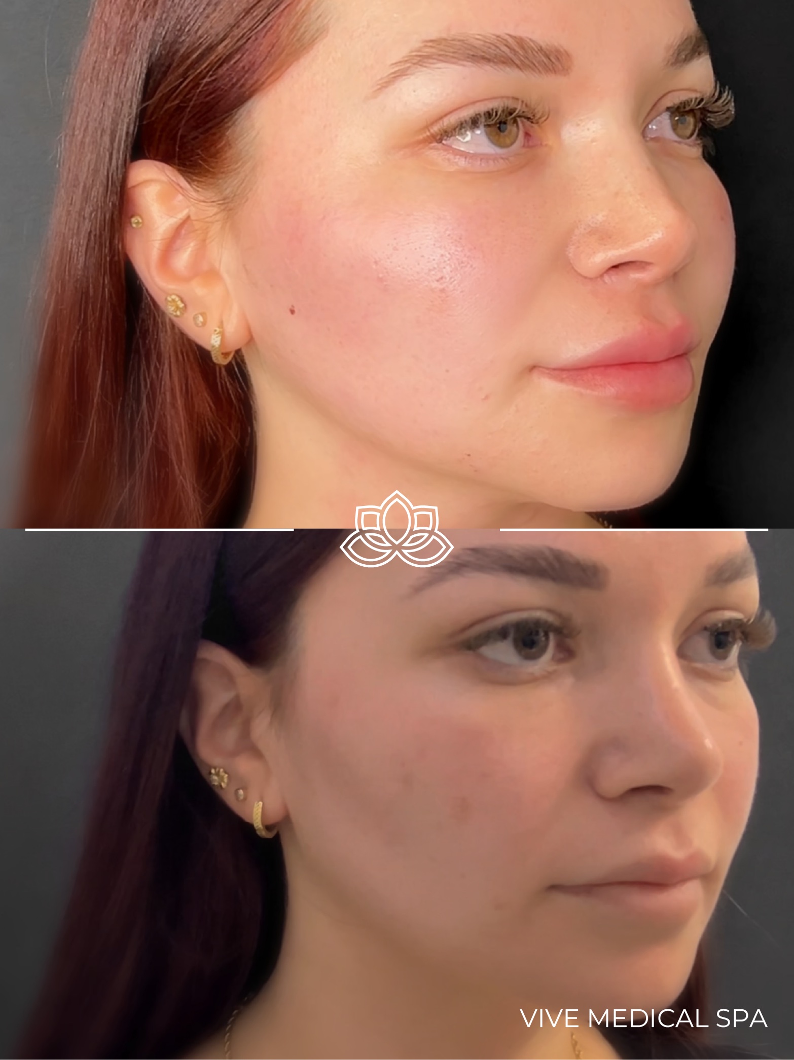 Juvelook hybrid skin rejuvenation clinical banner at Vive Medical Spa