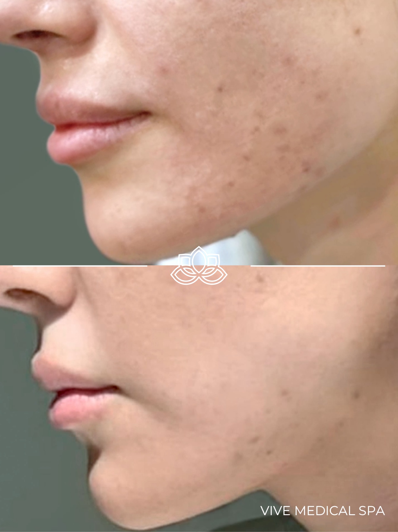 Kybella injectable treatment - deoxycholic acid fat reduction