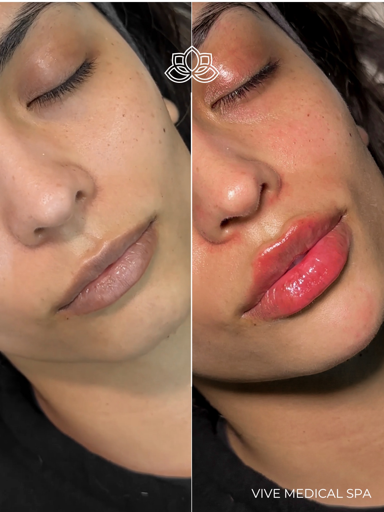Lip filler results at Vive Medical Spa Tijuana - natural-looking enhancement