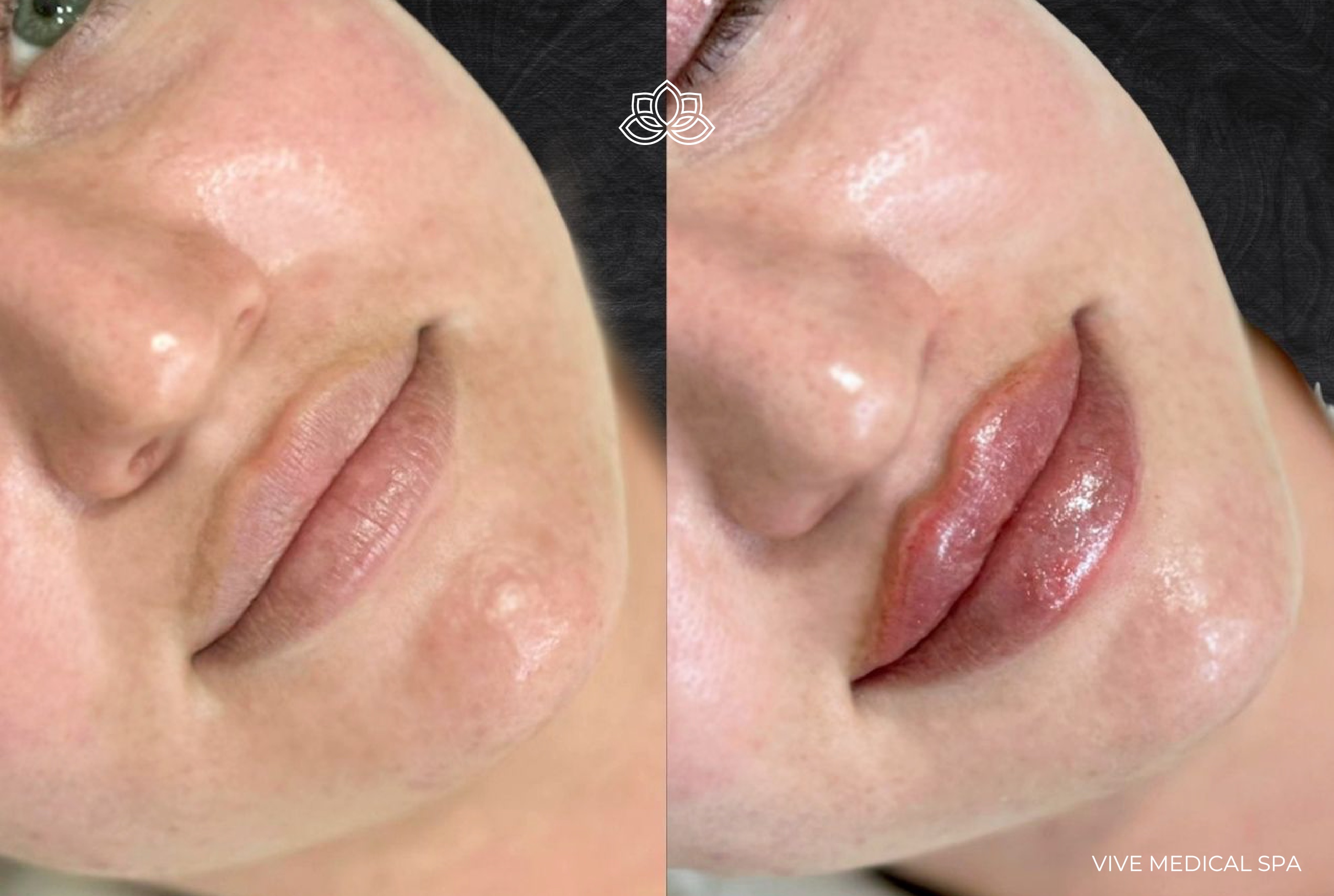 Lip filler results - Vive Medical Spa Tijuana