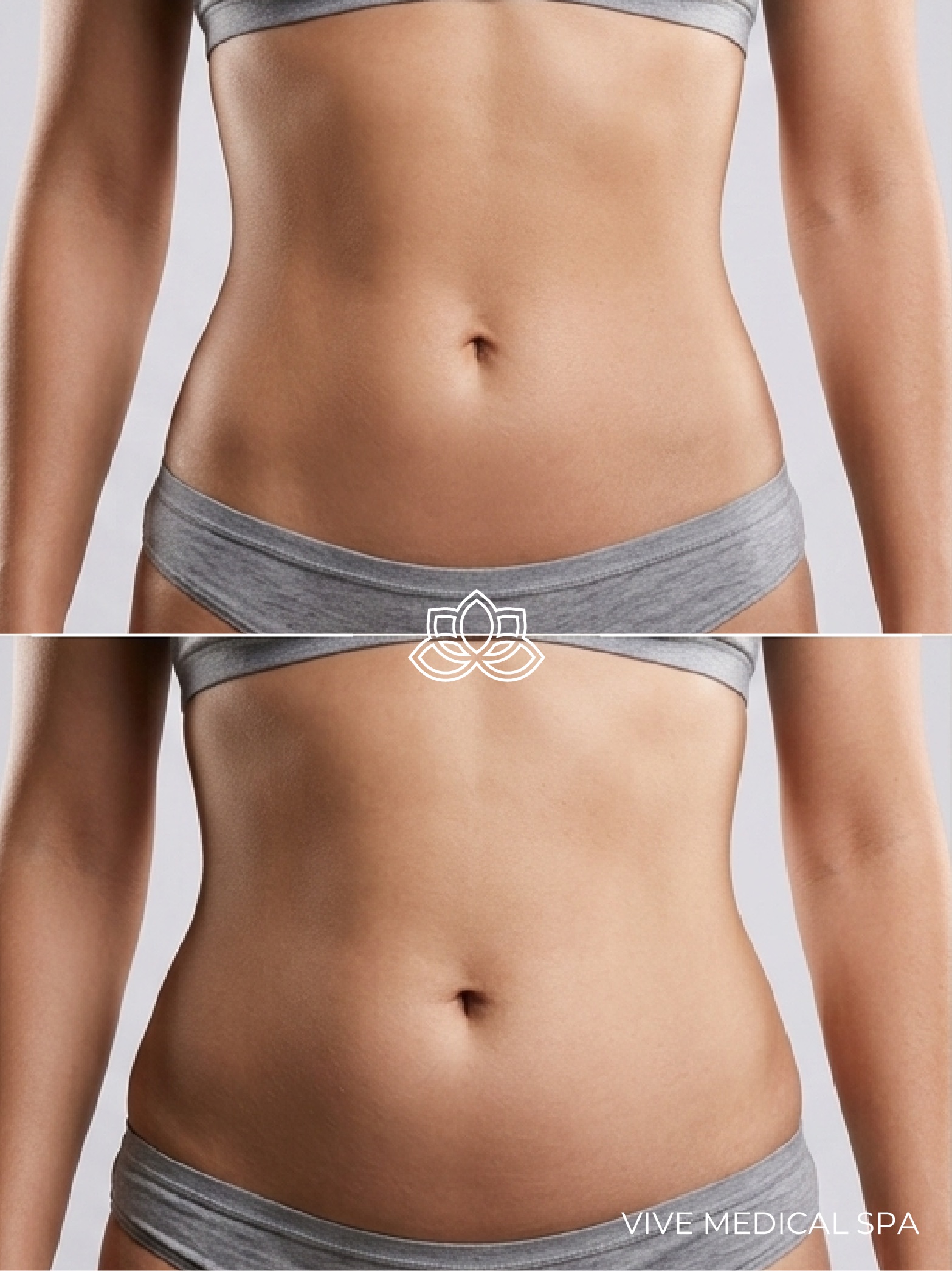 Liposonix at Vive Medical Spa Tijuana