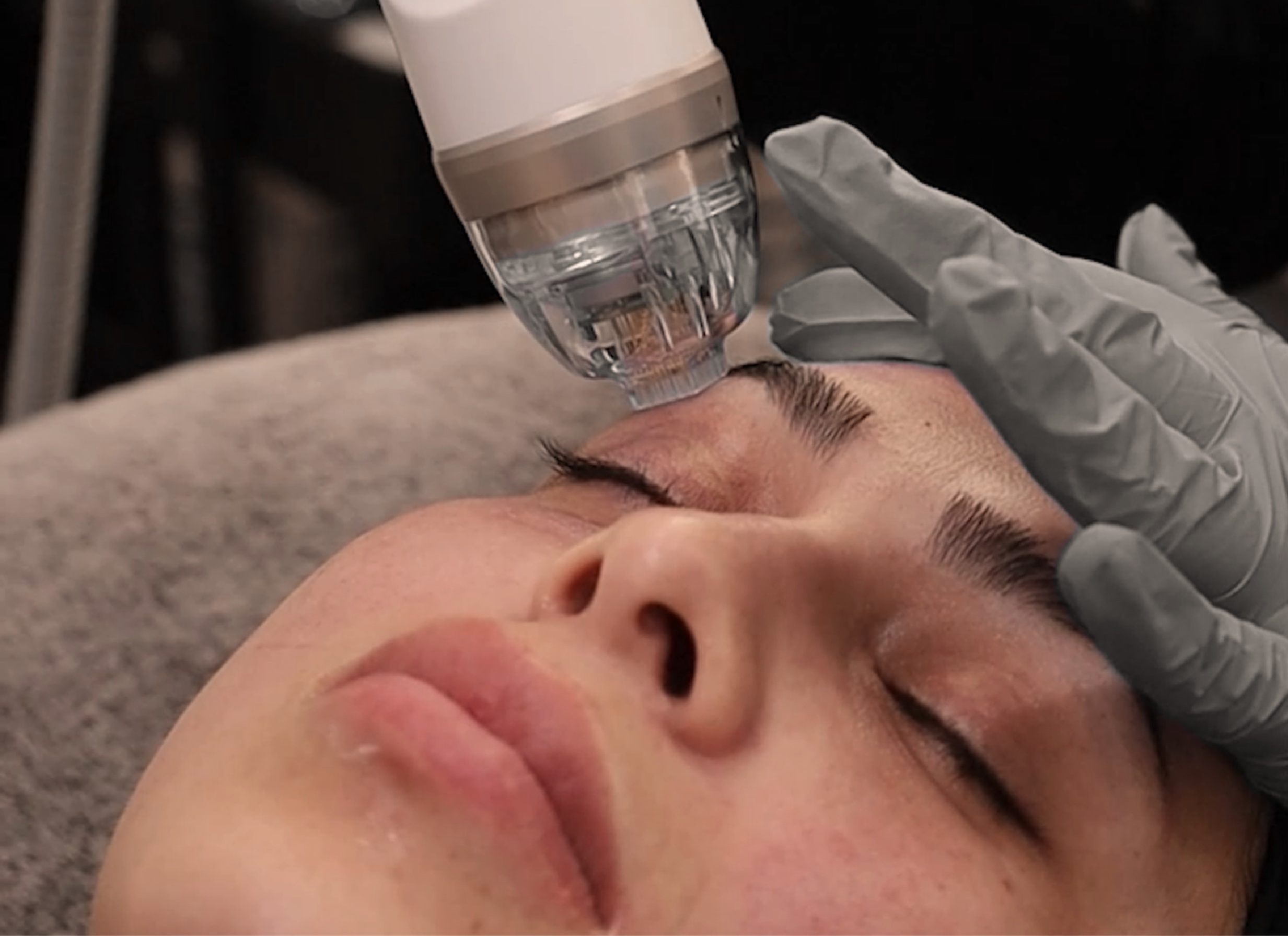 RF Microneedling procedure at Vive Med Spa