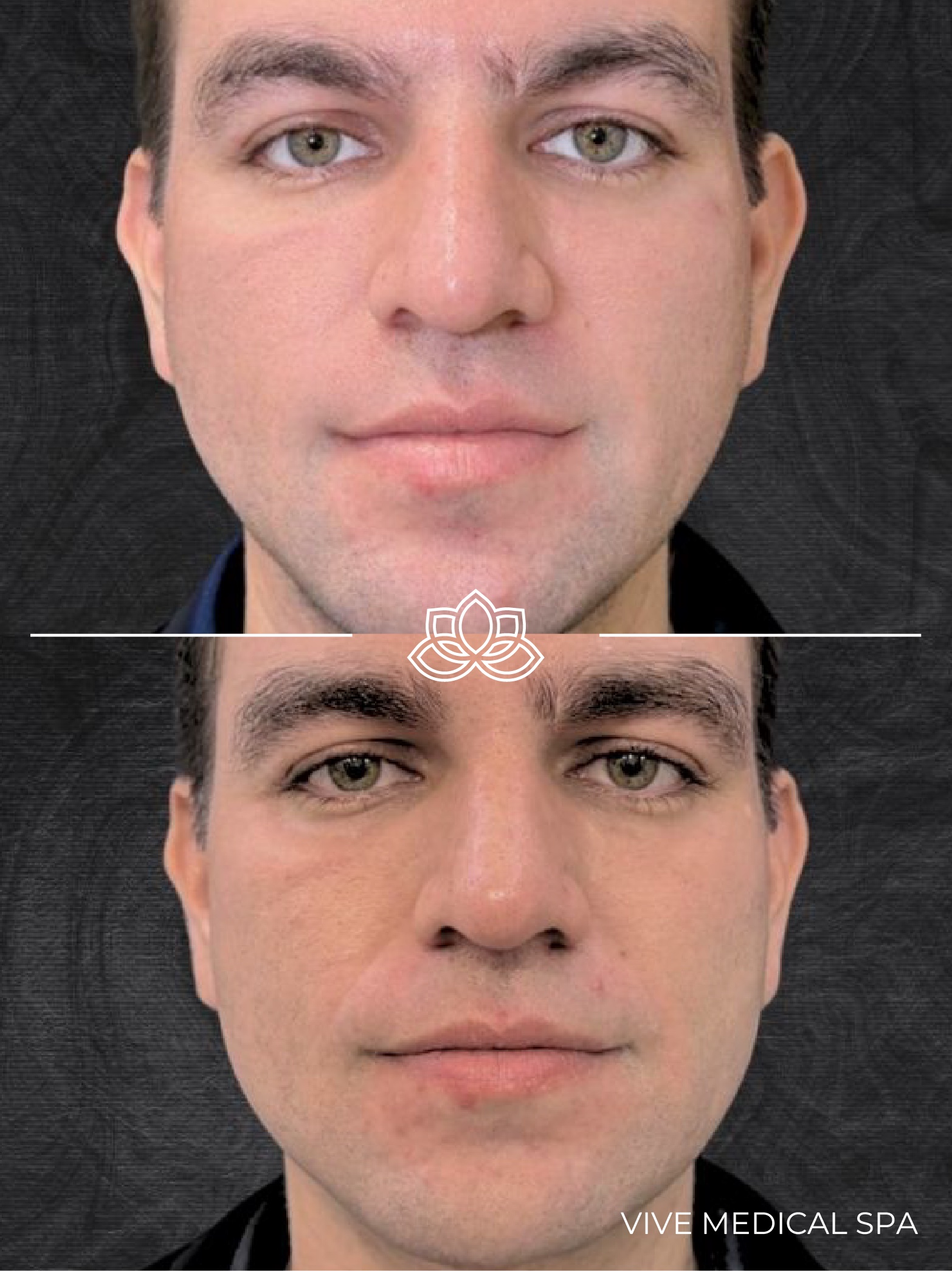 Morpheus8 radiofrequency microneedling results