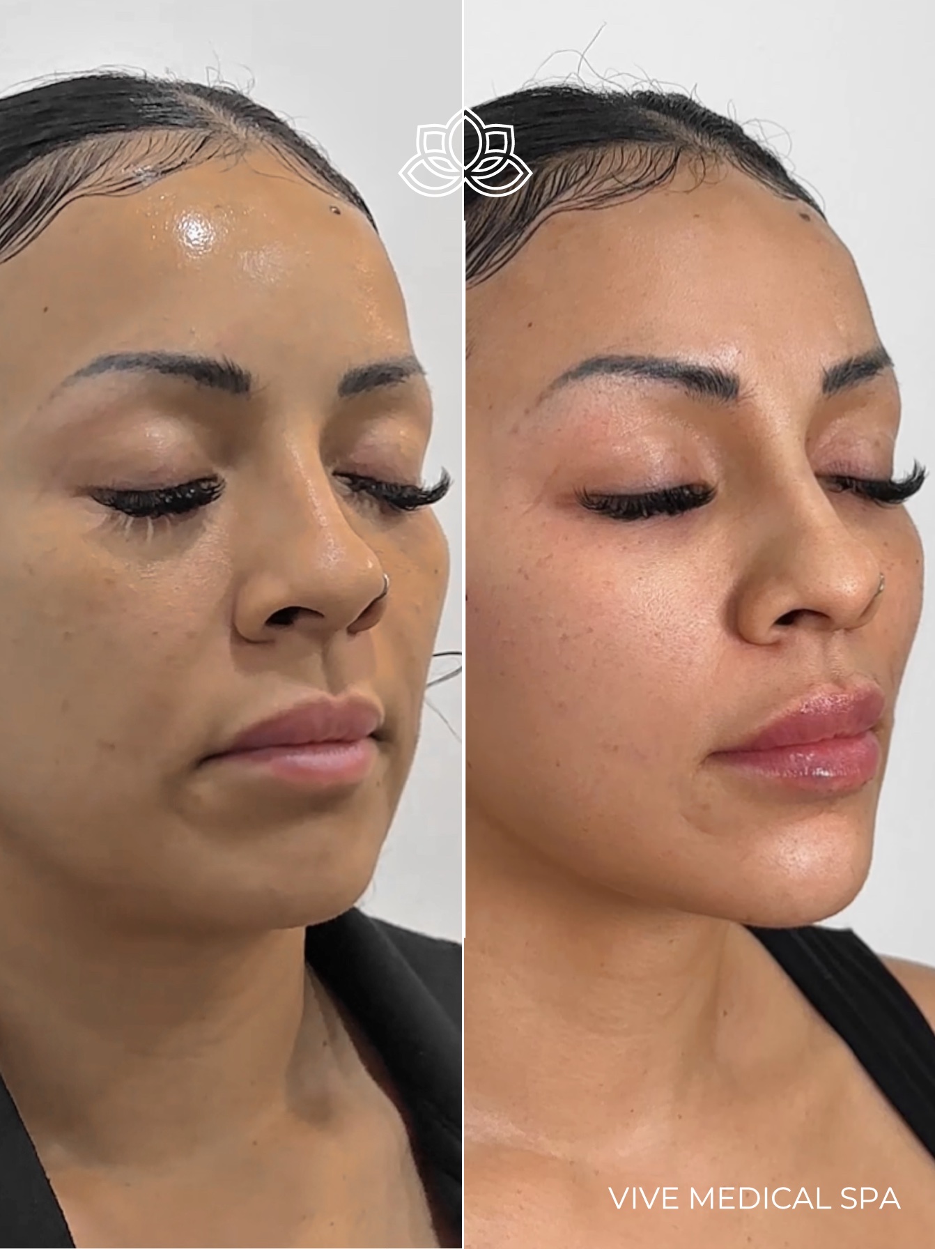 PDO thread treatment at Vive Medical Spa