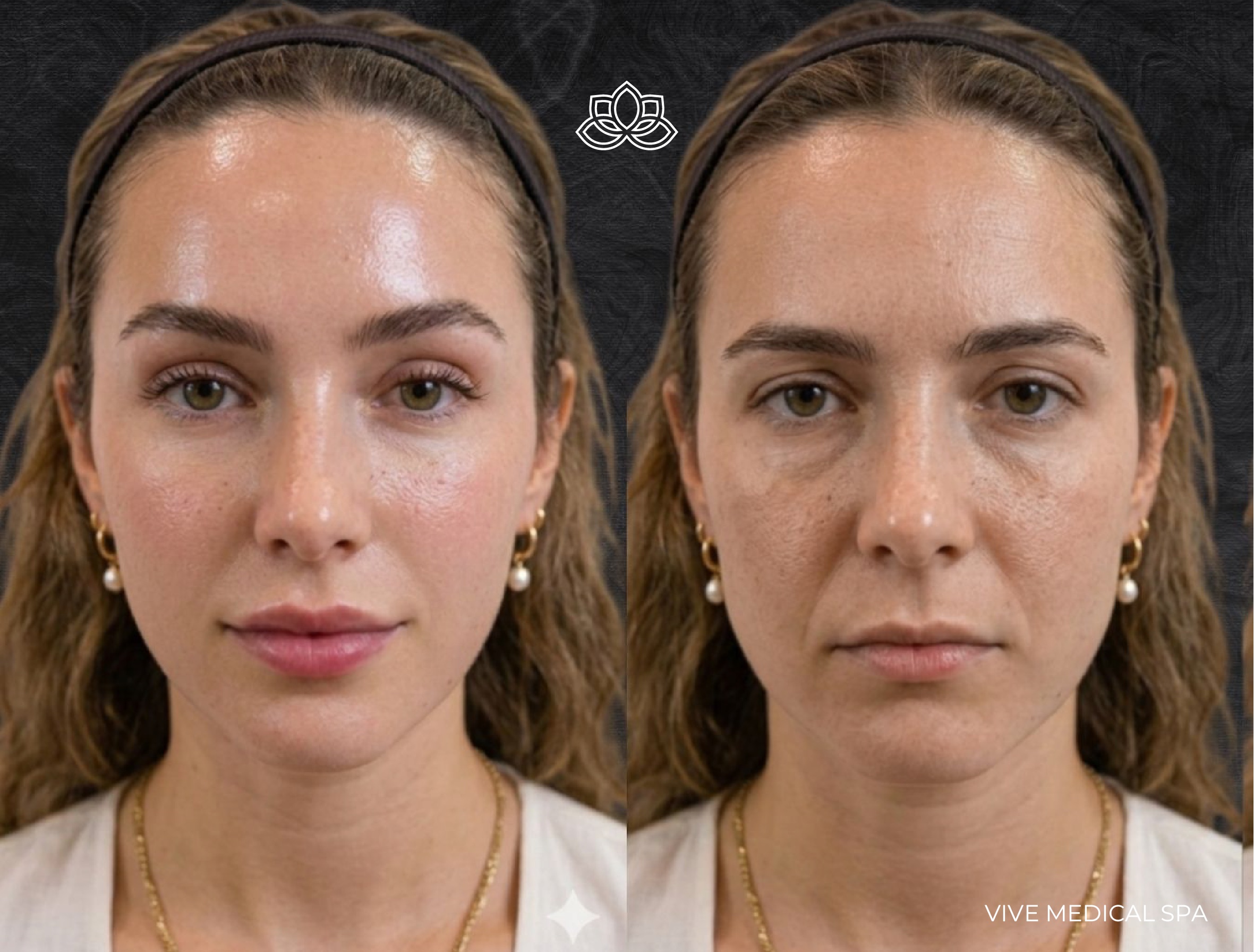 PDO thread results at Vive Medical Spa