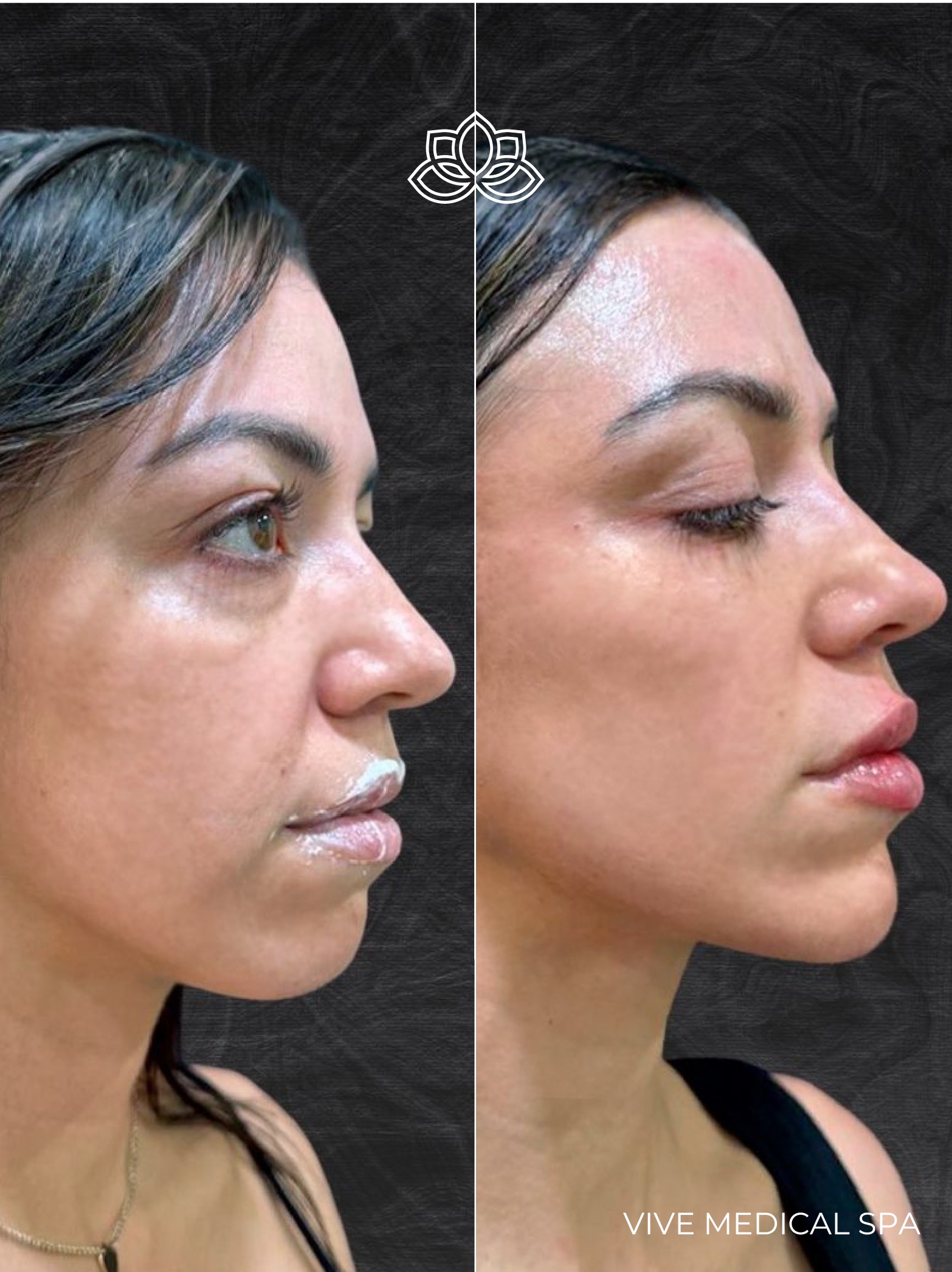 Sculptra at Vive Medical Spa Tijuana