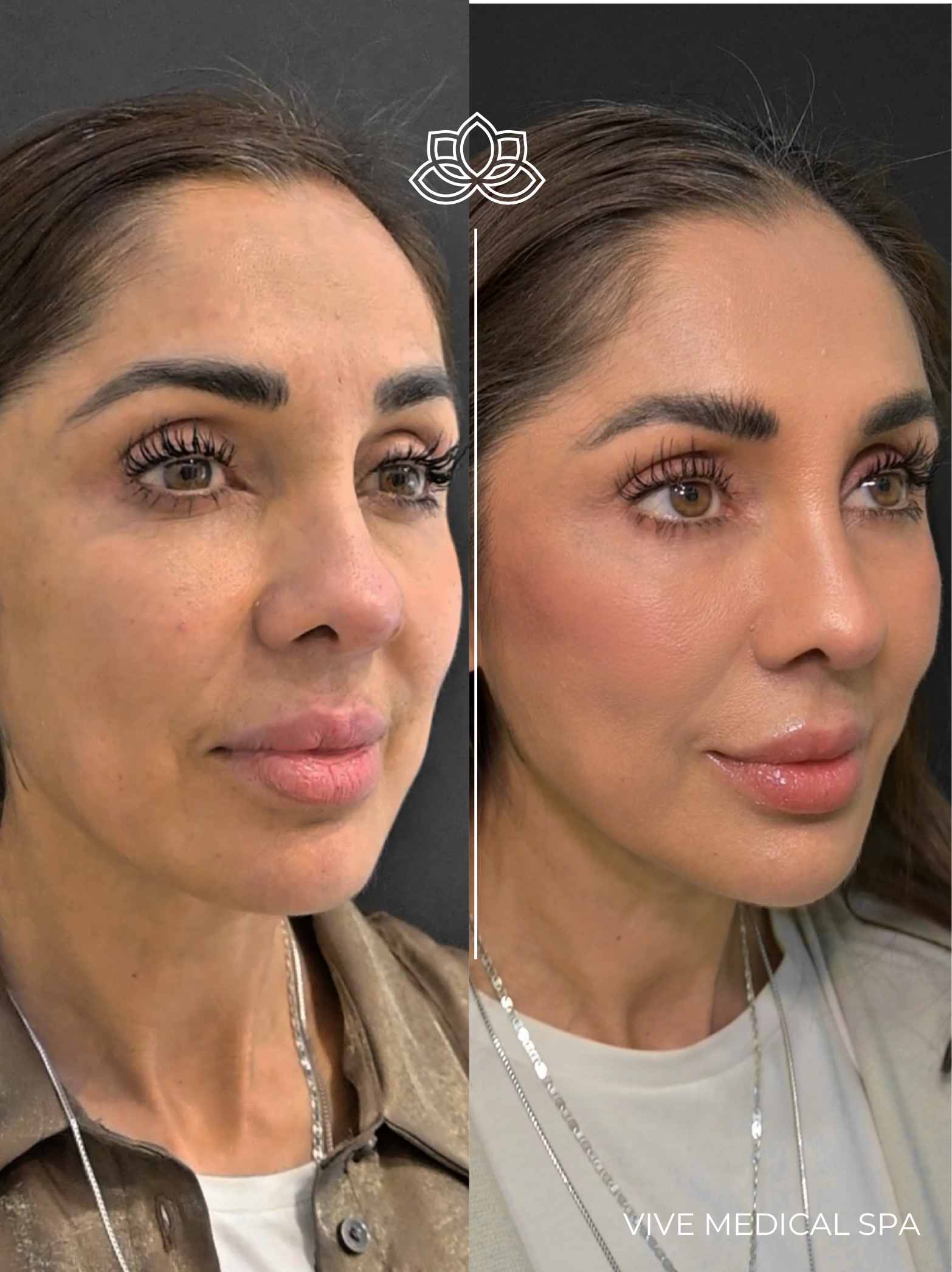 Ultraformer MPT ultrasound facelift at Vive Med Spa Tijuana, Mexico - non-surgical lifting